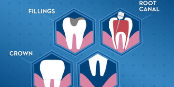 No More Fear: Scientists Find a Way to Stop Tooth Decay Without Drilling