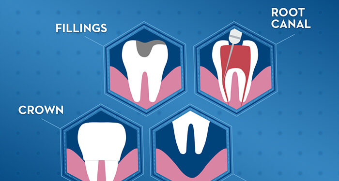 No More Fear: Scientists Find a Way to Stop Tooth Decay Without Drilling