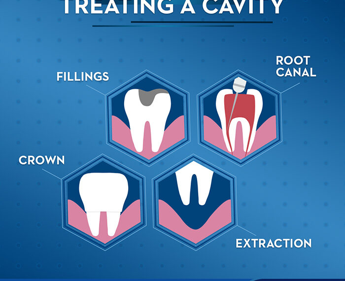No More Fear: Scientists Find a Way to Stop Tooth Decay Without Drilling