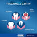 No More Fear: Scientists Find a Way to Stop Tooth Decay Without Drilling