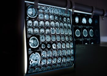 Speech Patterns May Provide Early Indicators of Brain Aging