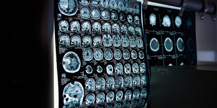 Speech Patterns May Provide Early Indicators of Brain Aging